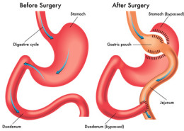 Treating Weight Regain after Weight-Loss Surgery